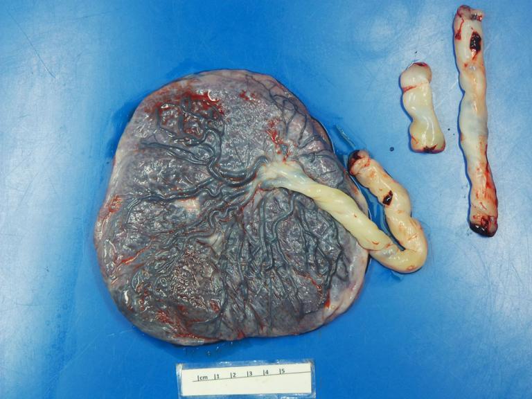 Placenta de embarazada con COVID-19 muestra lesiones