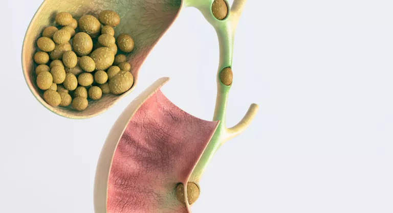 Litiasis biliar: infografía