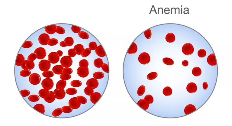 Infograía: anemia