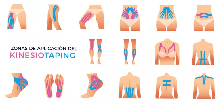 suerte Escoger lanzador Kinesiotaping o vendaje neuromuscular, qué es - Medicina deportiva