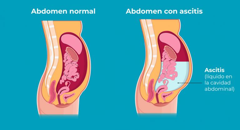 Ascitis, acúmulo de líquido en el abdomen: ilustración