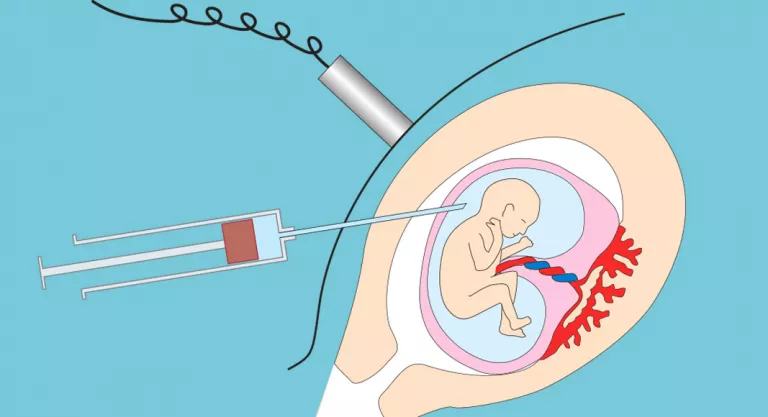 Diagnóstico del síndrome de Turner: Amniocentesis