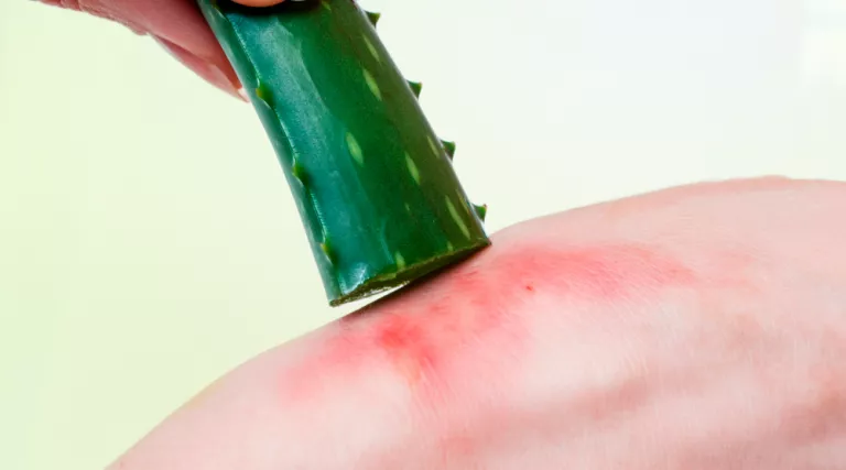 Dermatitis alérgica provocada por el aloe vera