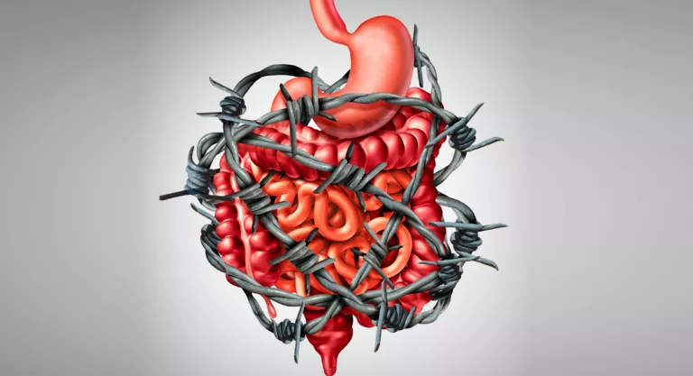 Síndrome del intestino irritable