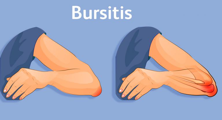 A térdízület suprapatellaris bursitisének kezelése, Fájó fájdalmak a váll és a könyök ízületeiben