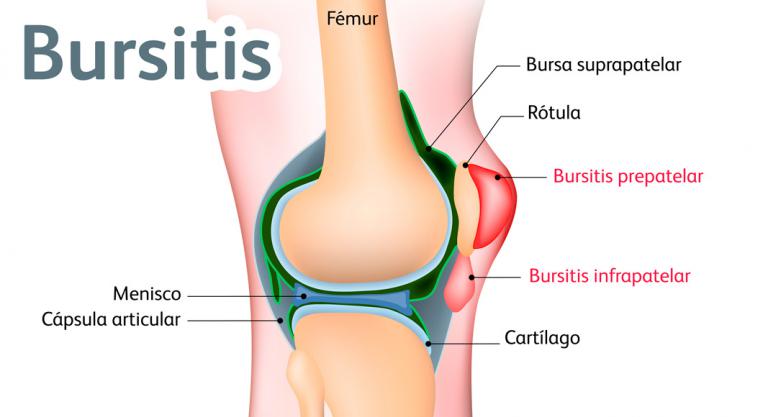 Bursitis en la rodilla
