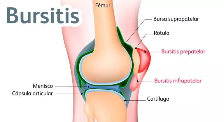 Bursitis ejemplo imagen