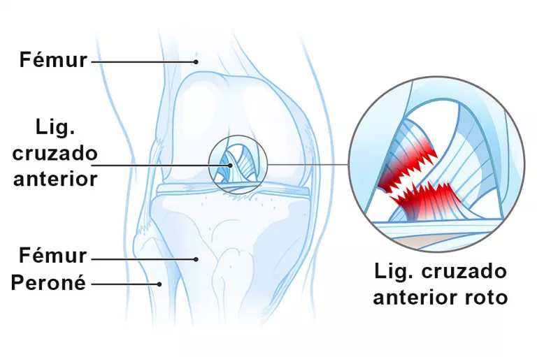 Rotura del ligamento cruzado