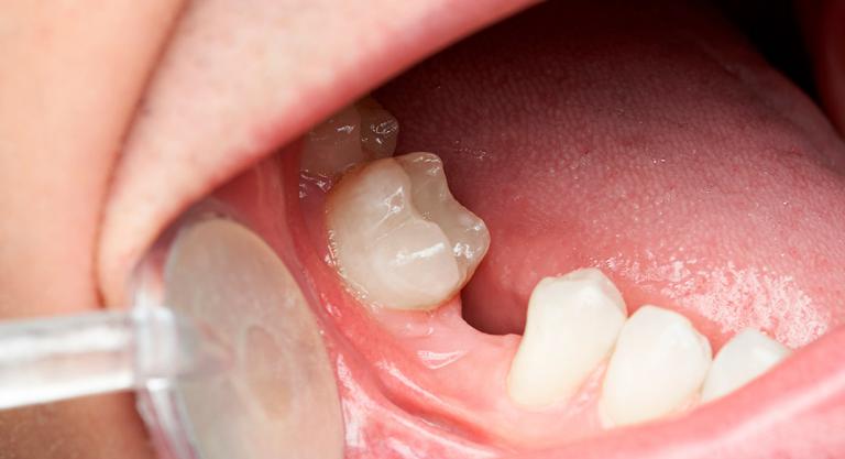 Pérdida dental: ausencia permanente