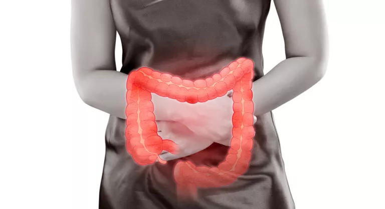 Colitis ulcerosa