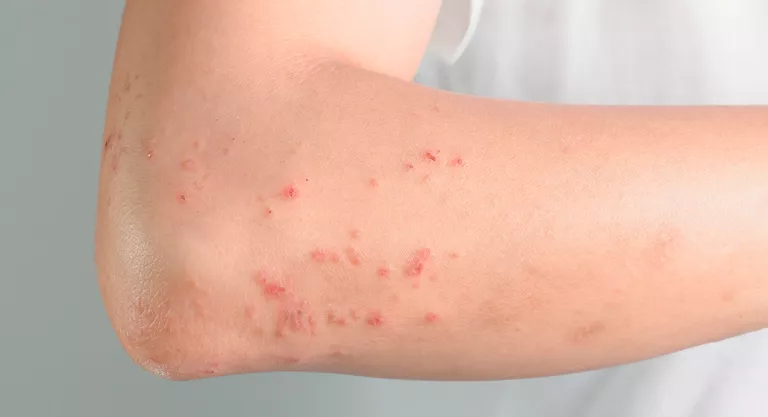 Brazo con alergia cutánea y urticaria