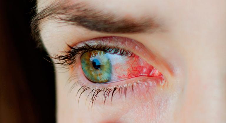 Síntomas de alergia en los ojos