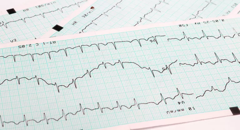 Arritmias cardiacas, recupera el ritmo de tu corazón