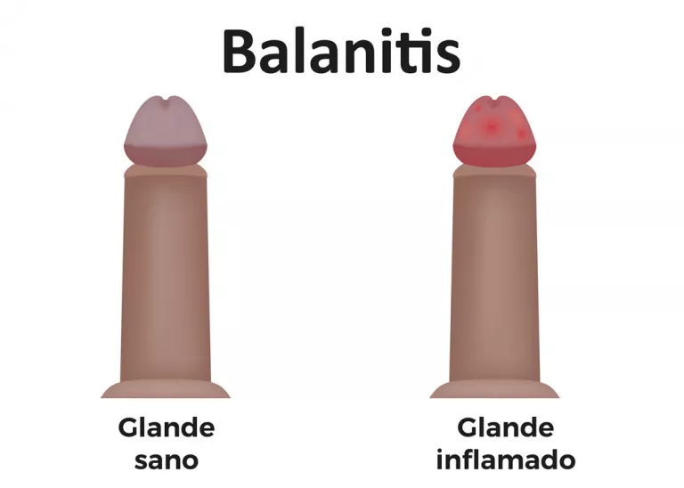 Balanitis