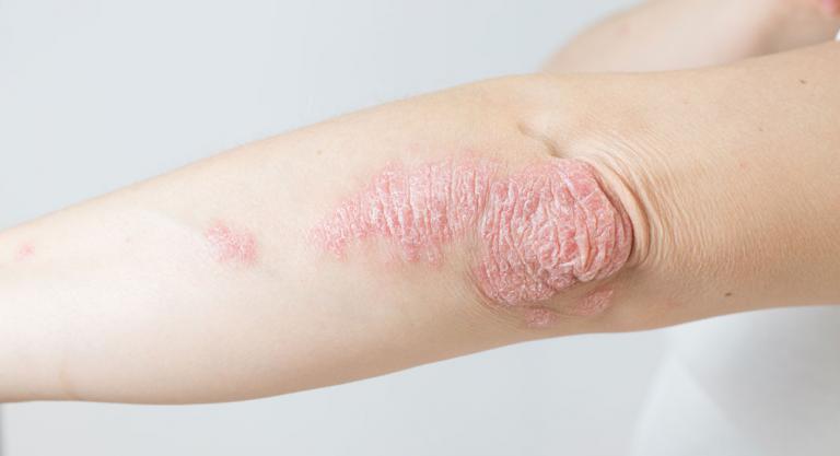 Causas de la aparición de psoriasis en la piel