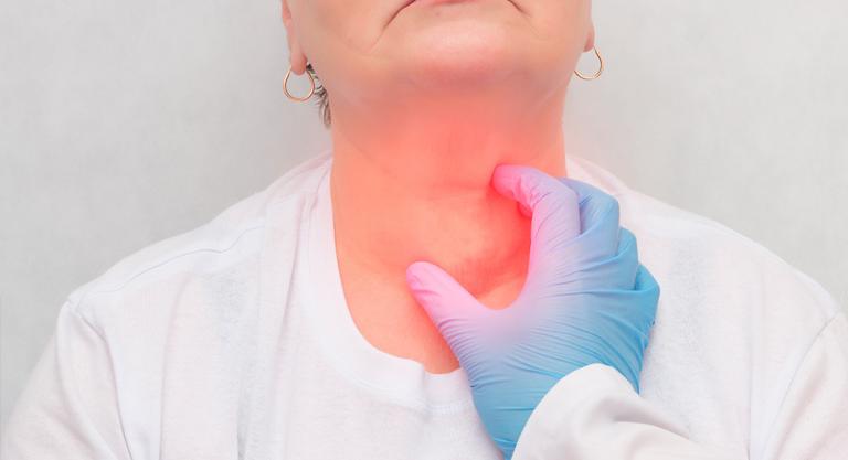 Bocio, problemas en la glándula tiroides