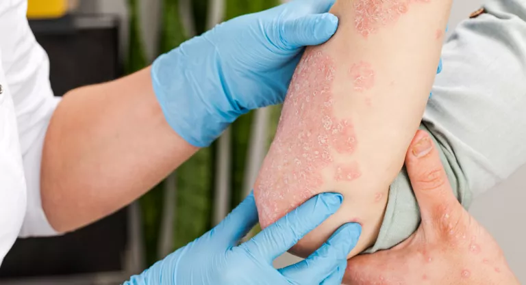 Diagnóstico de la psoriasis en el dermatólogo