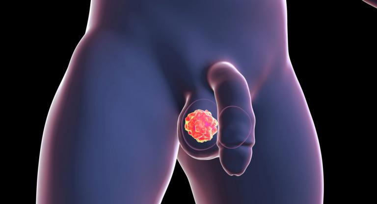 Clasificación pronóstica del cáncer de testículo