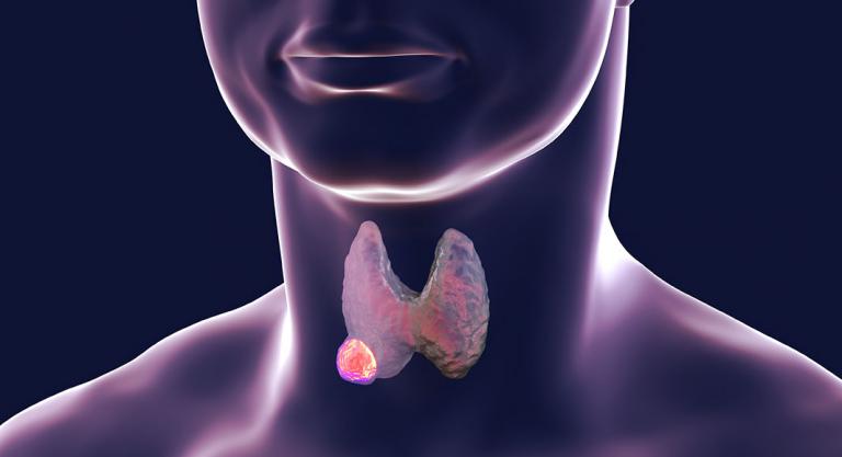 Tipos de cáncer de tiroides