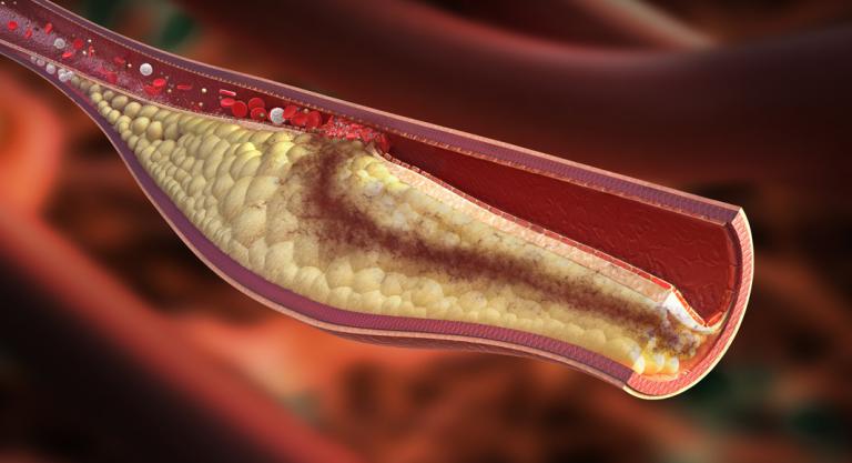 Causas de la insuficiencia renal crónica: colesterol