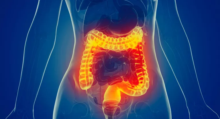 Diverticulosis