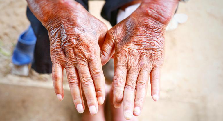 Esclerodermia: engrosamiento y endurecimiento de la piel
