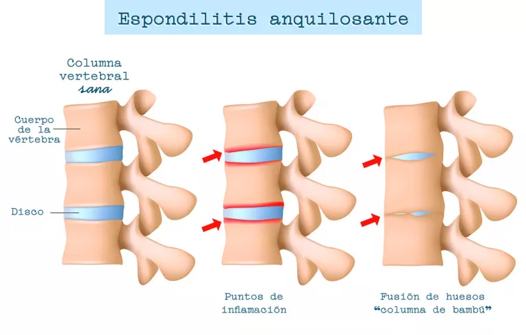 Síntomas de la espondilitis anquilosante