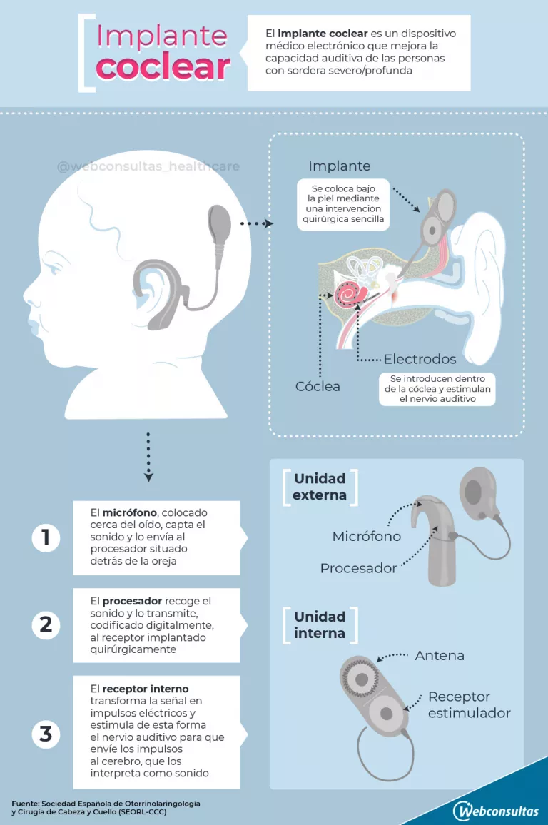 Implante coclear, cómo funciona (infografía)