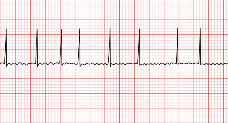 Control del ritmo cardiaco