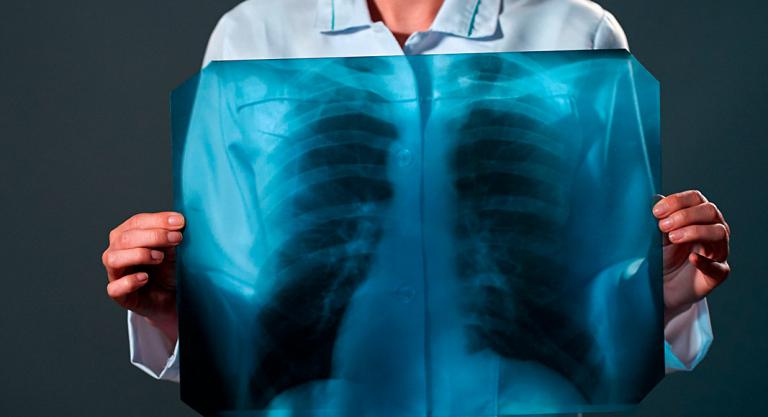 Diagnóstico de la tuberculosis