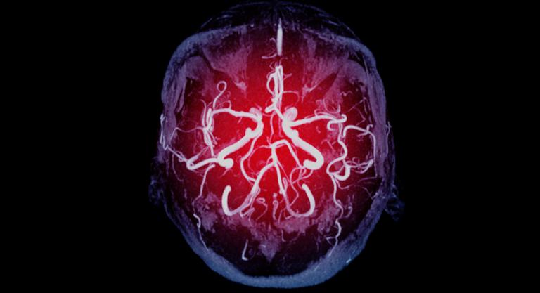 AstraZeneca: ¿Qué es la trombosis venosa cerebral?