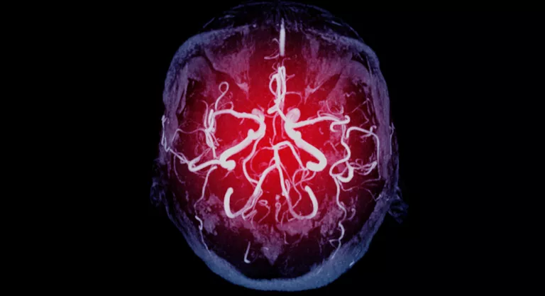 AstraZeneca: ¿Qué es la trombosis venosa cerebral?