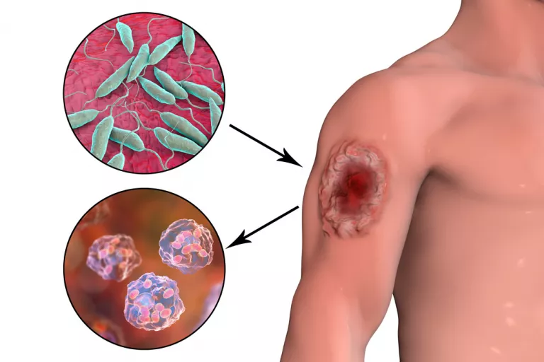 Síntomas y tipos de leishmaniasis