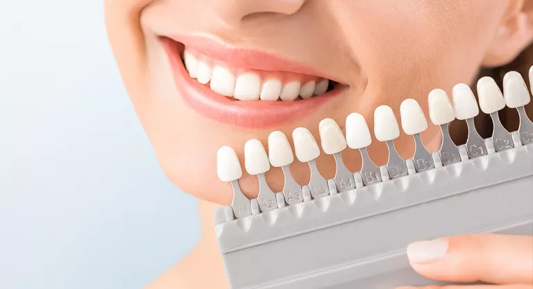 Blanqueamiento dental: técnicas para hacer lucir tu sonrisa