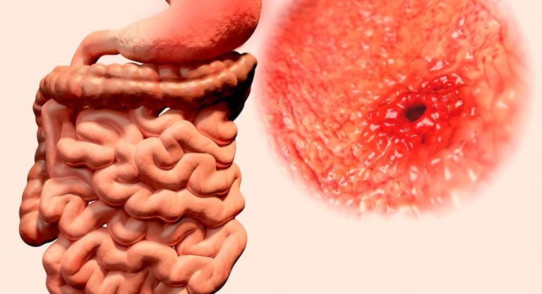 Complicaciones de una úlcera