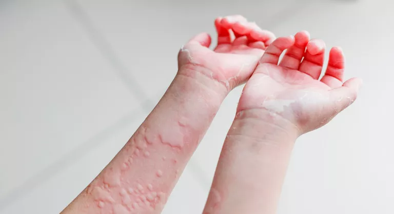 Urticaria, consejos para aliviar sus molestos picores