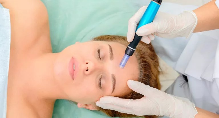 Mesoterapia facial, para el acné y el cabello