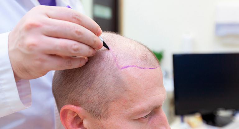Trasplante capilar, recurso eficaz para repoblar tu pelo 