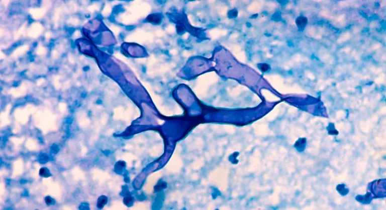 Mucormicosis u hongo negro, nueva amenaza COVID-19