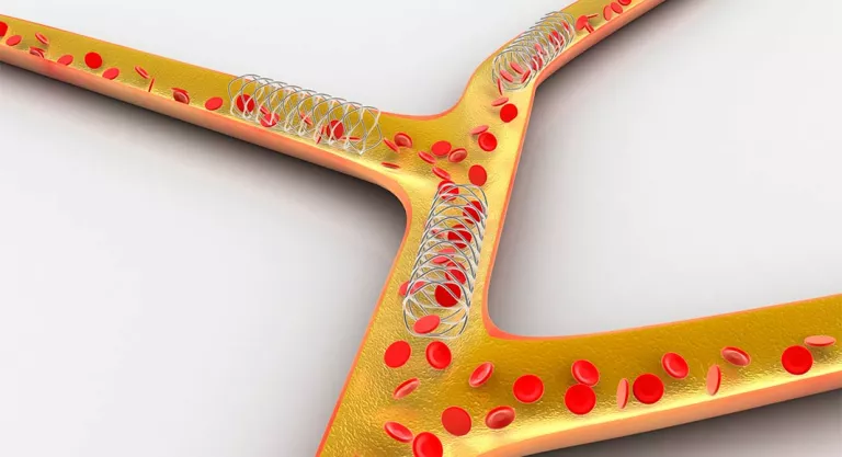 Stent coronario