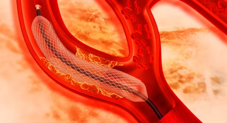 Stent coronario, colocación