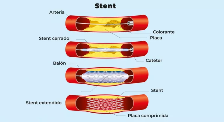 Stent coronario