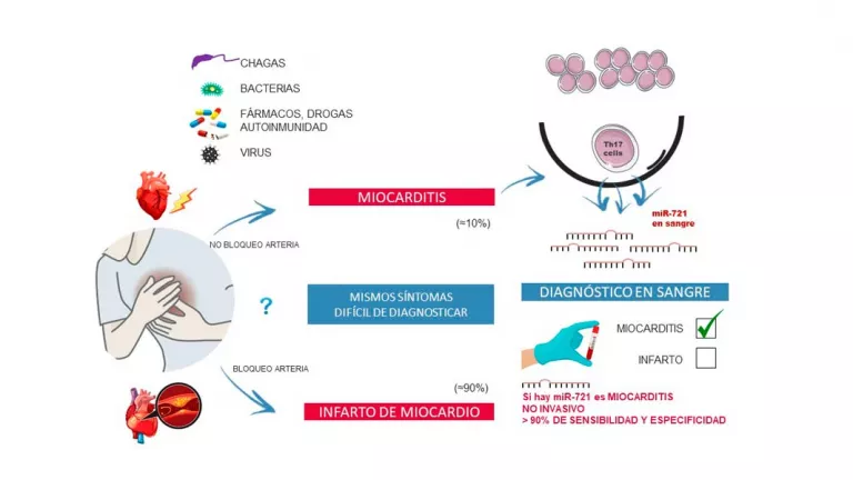 Cómo diagnosticar la miocarditis con una gota de sangre