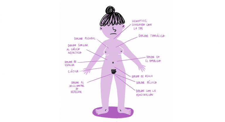 Ilustración del libro endometriosis del Dr. Francisco Carmona