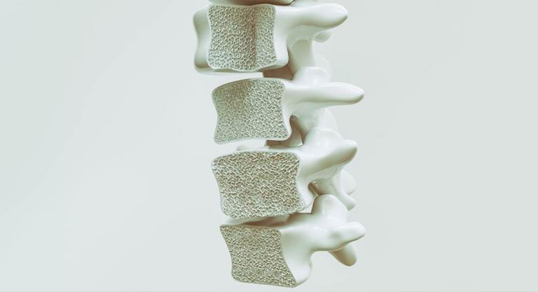 Columna vertebral afectada por la osteoporosis