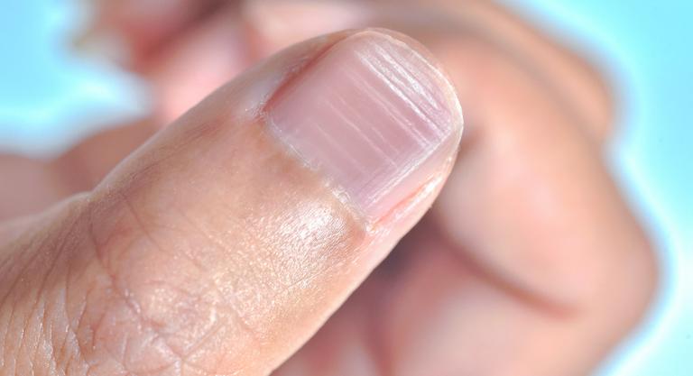 Cambios en las uñas asociados al COVID-19: líneas de beau