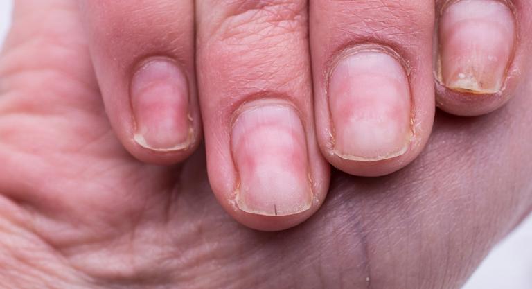 Cambios en las uñas asociados al COVID-19: Onicomadesis