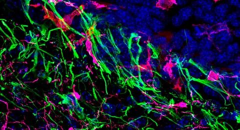 Metástasis cerebral del melanoma