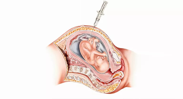 Amnioscopia para detectar la pérdida de bienestar fetal