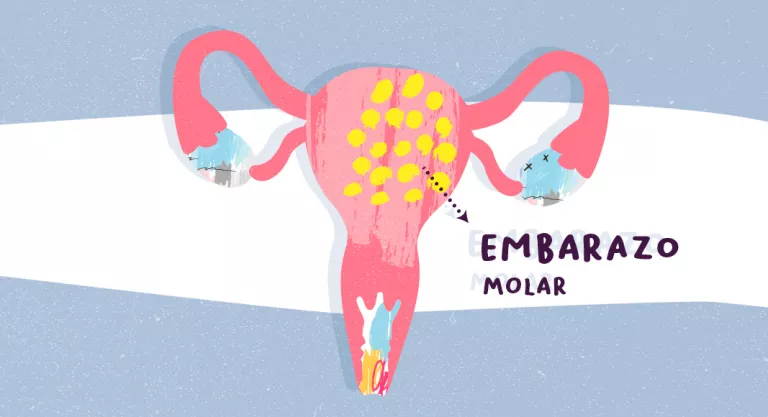 Embarazo molar